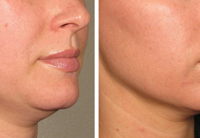 Chin Lift Results