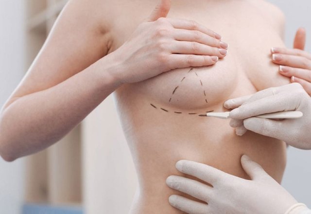 Procedure of Breast Lift Surgery