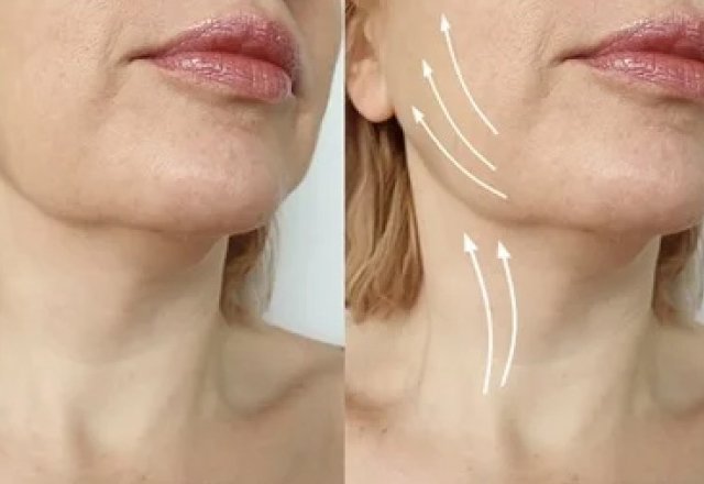 Short-scar facelift Surgery