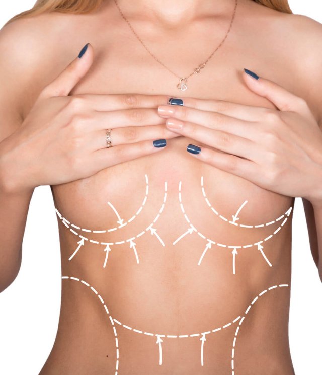 Right Candidate for Breast Reduction Treatment