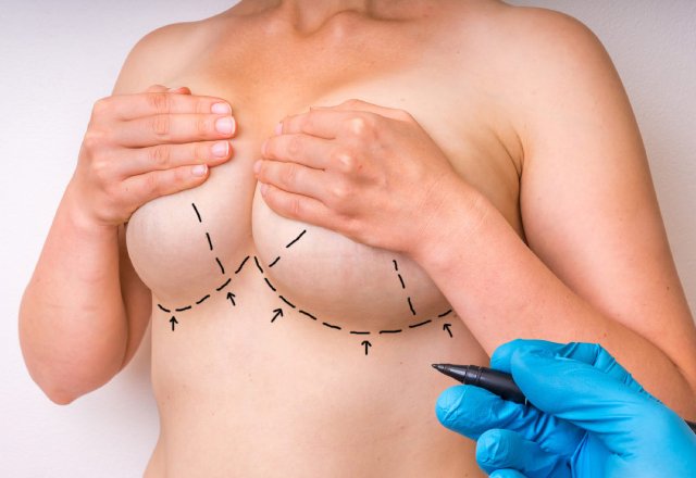 Why Breast Reduction Surgery